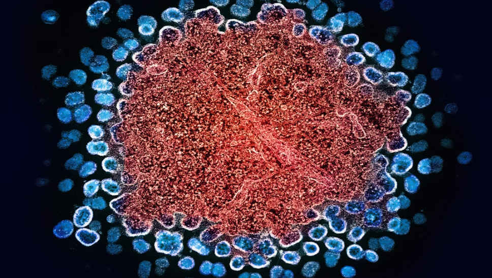 Pakistan HIV outbreak linked to unsafe hospital practices 1 HIV outbreak in Punjab. Pakistan