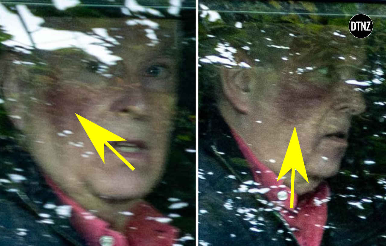 Andrew seen with huge facial bruise 1 Prince Andrew face bruise